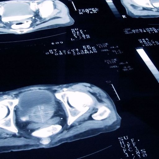 
                              Why I'm urging other men to get checked for prostate cancer
                      